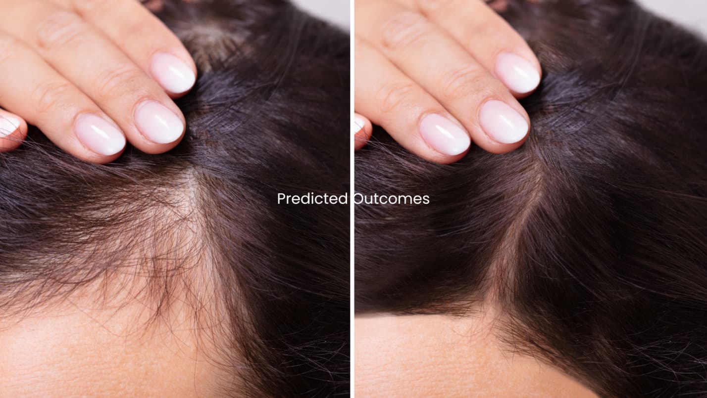 stem cell hair therapy before and after